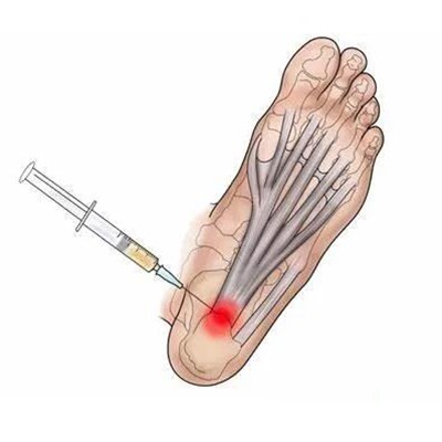 足底筋膜炎丨走出来的脚底板痛